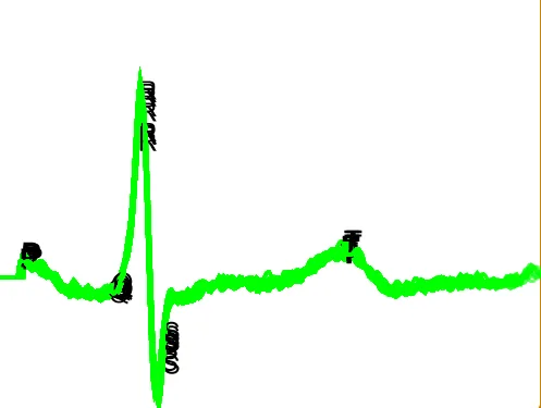 Complejo QRS con los puntos fiduciarios P, Q, R, S y T marcados