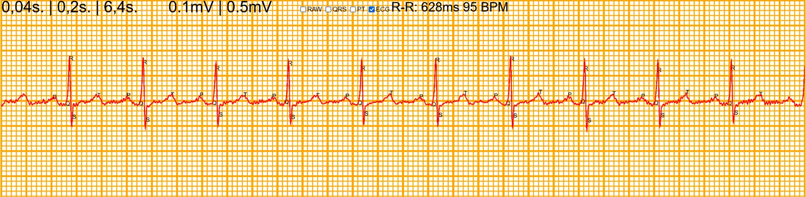 Trazado del ECG en tiempo real en el navegador, con ritmo cardíaco en pulsaciones por minuto